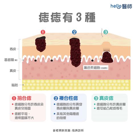 長痣原因